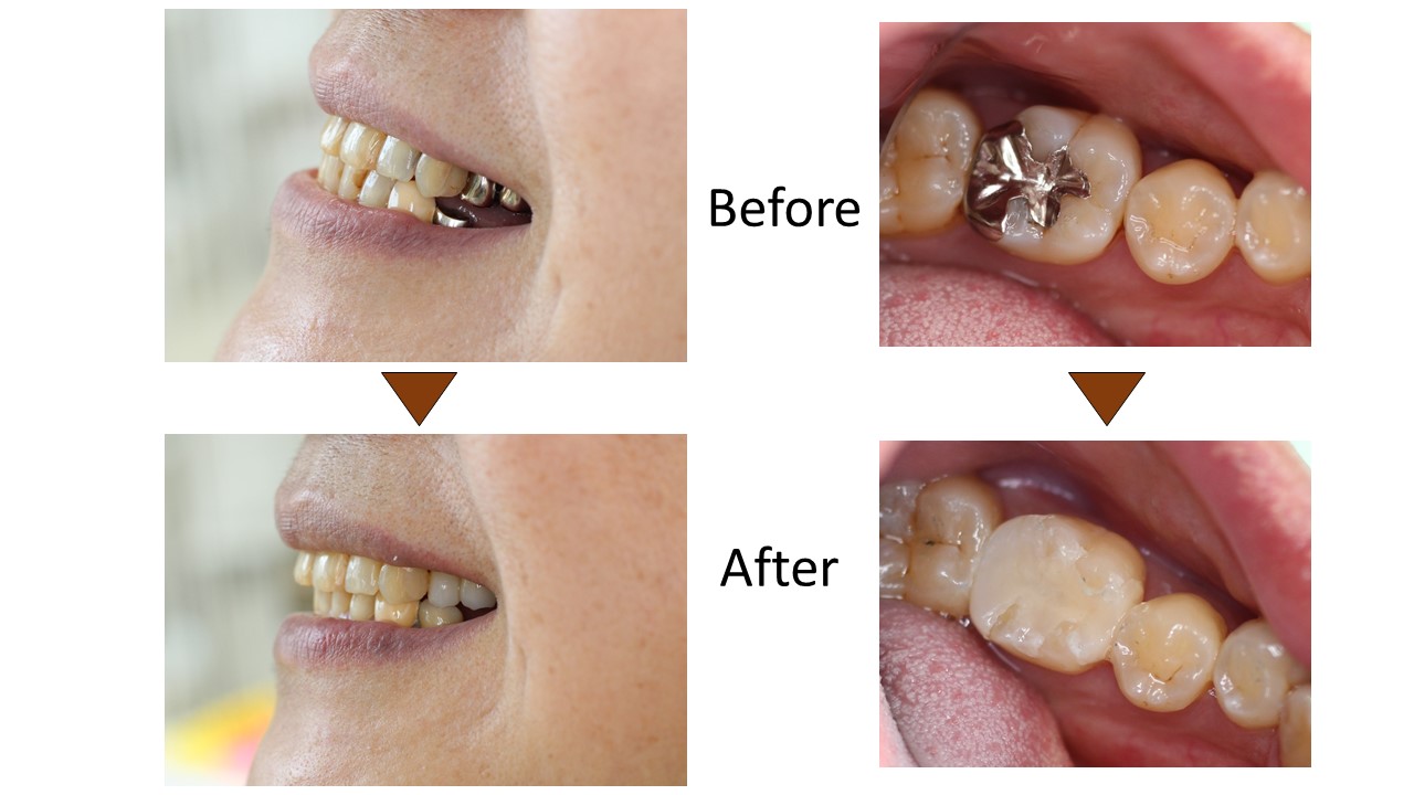 メタルフリー治療 ノンメタル治療 兼松歯科医院